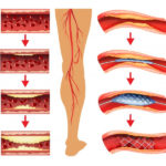 revascularizarea-piciorului-diabetic