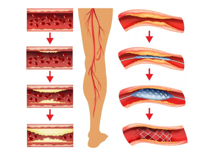 revascularizarea-piciorului-diabetic