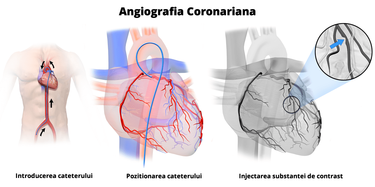 coronarografie-angiografie-coronariana