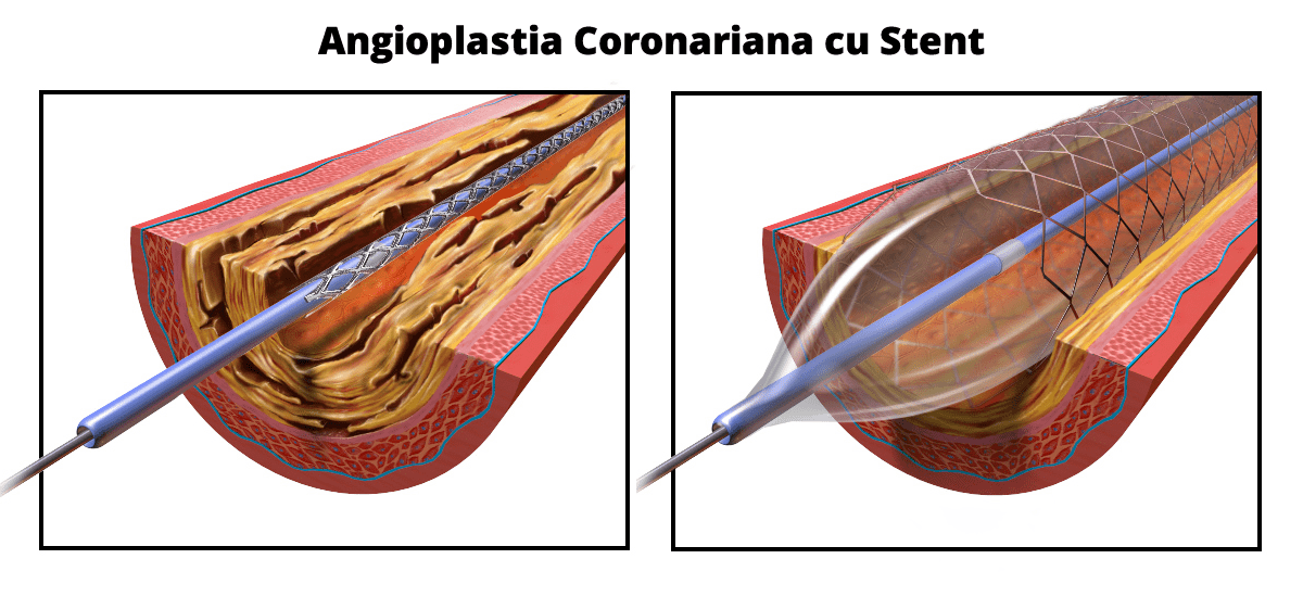 angioplastie